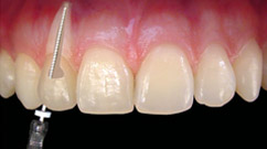 GOE - Implantodontia no Gutierrez - BH - Implantes Dentrios e Prteses no Gutierrez - BH