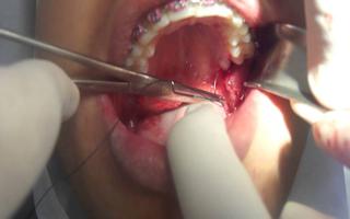 GOE -  Implantes Dentrios e Prtese na Savass